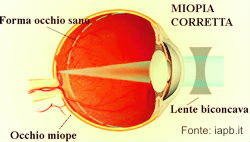 Miopia e retina